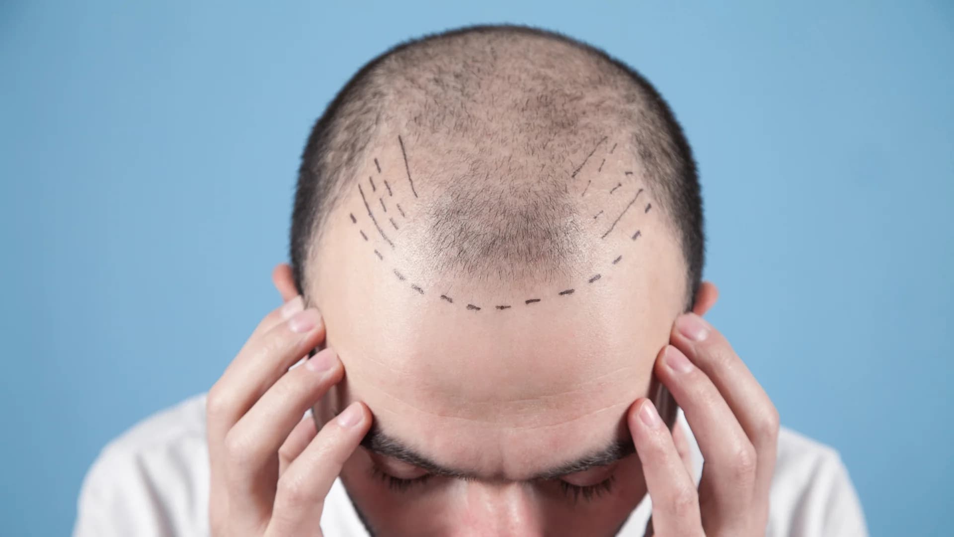 Hair Restoration