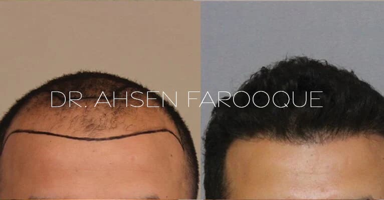 before-after-1